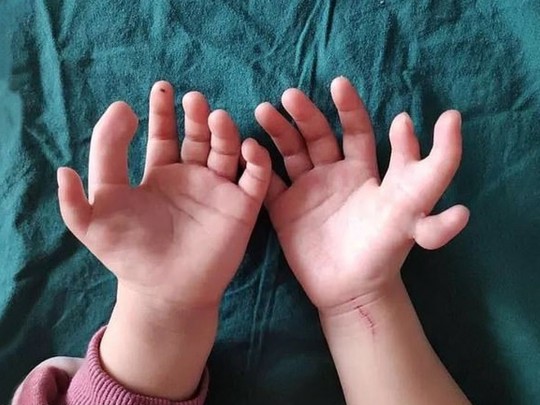 Девочке с 14 пальцами на руках врачи удалили лишние (фото)