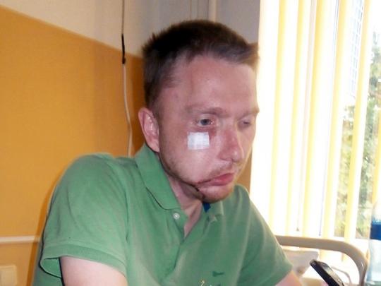«Полтора года я был без челюсти. Ни есть, ни говорить нормально не мог»